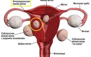 Миома матки — виды, причины, симптомы, диагностика, лечение